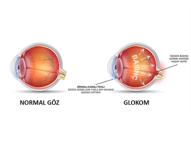 GÖZ TANSİYONU GÖRME KAYBINA NEDEN OLUYOR